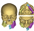 Advanced reconstructive methods of maxillofacial trauma at the Barzilai medical center